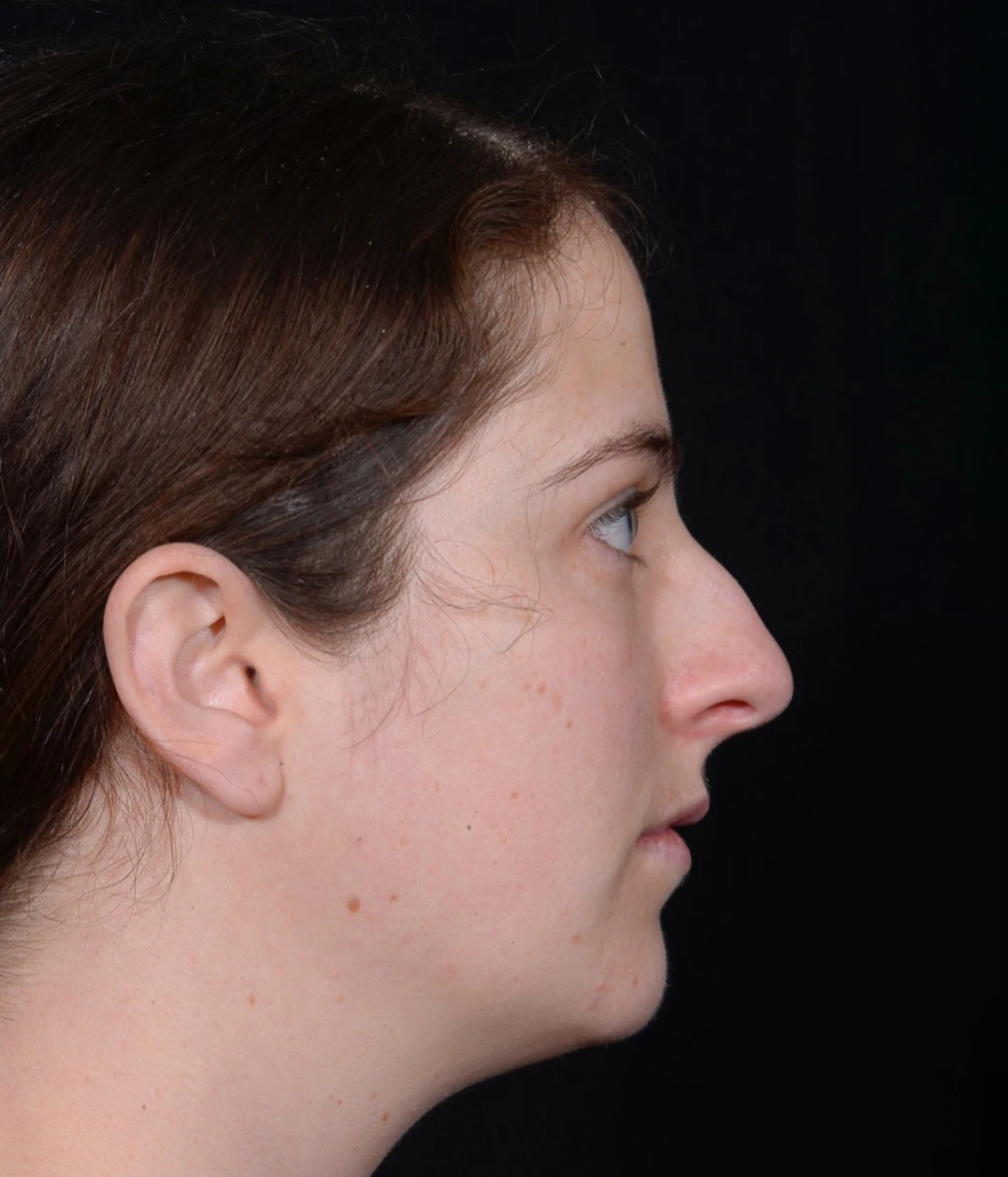 Rhinoplasty-and-Chin-Implant-Case--381 | Before Rhinoplasty 4