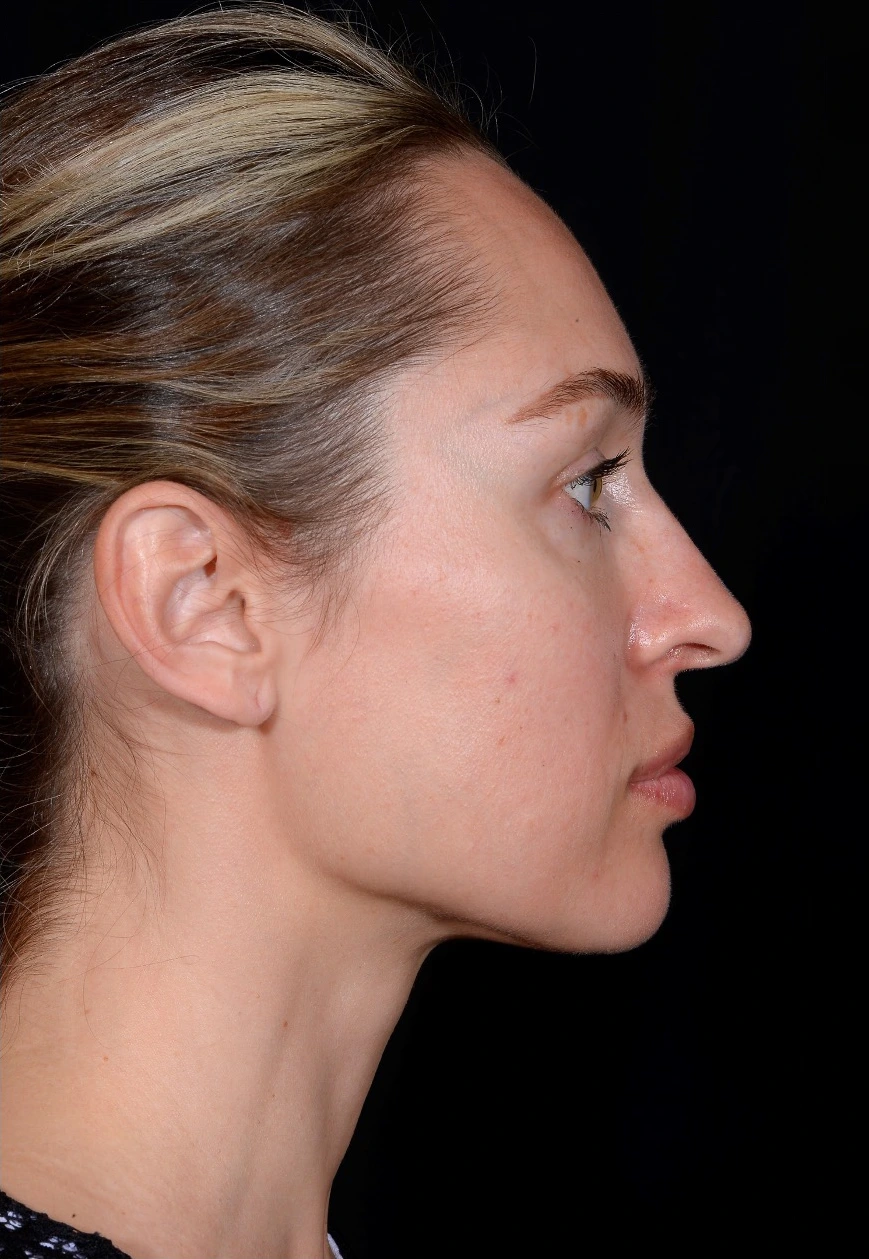 Rhinoplasty-Case--378 | Before Rhinoplasty 3