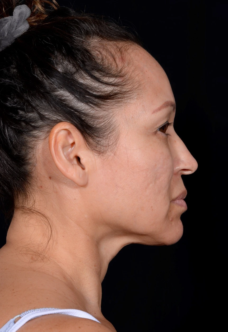 Facelift-Case--364 | Before Facelift 3