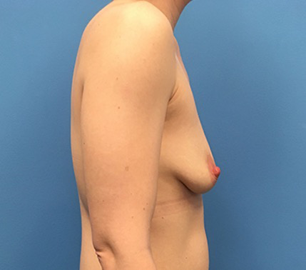 Breast-Augmentation-Case--93 | Before Breast Augmentation 3