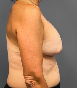 Augmentation-Mastopexy-Case--1213 | Before Breast Augmentation With Lift 2