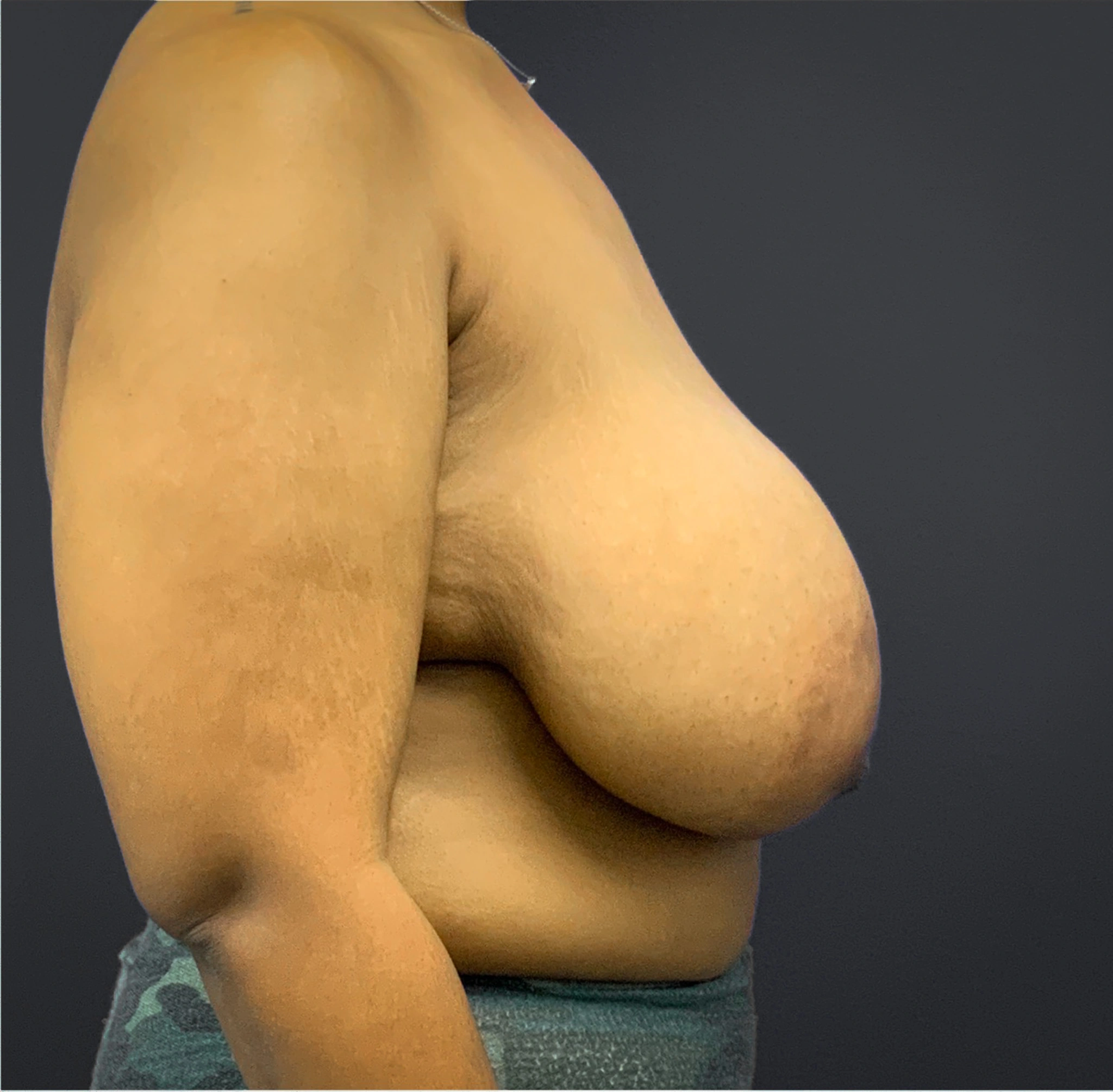 Breast-Reduction-Case--5320 | Before Breast Reduction 3