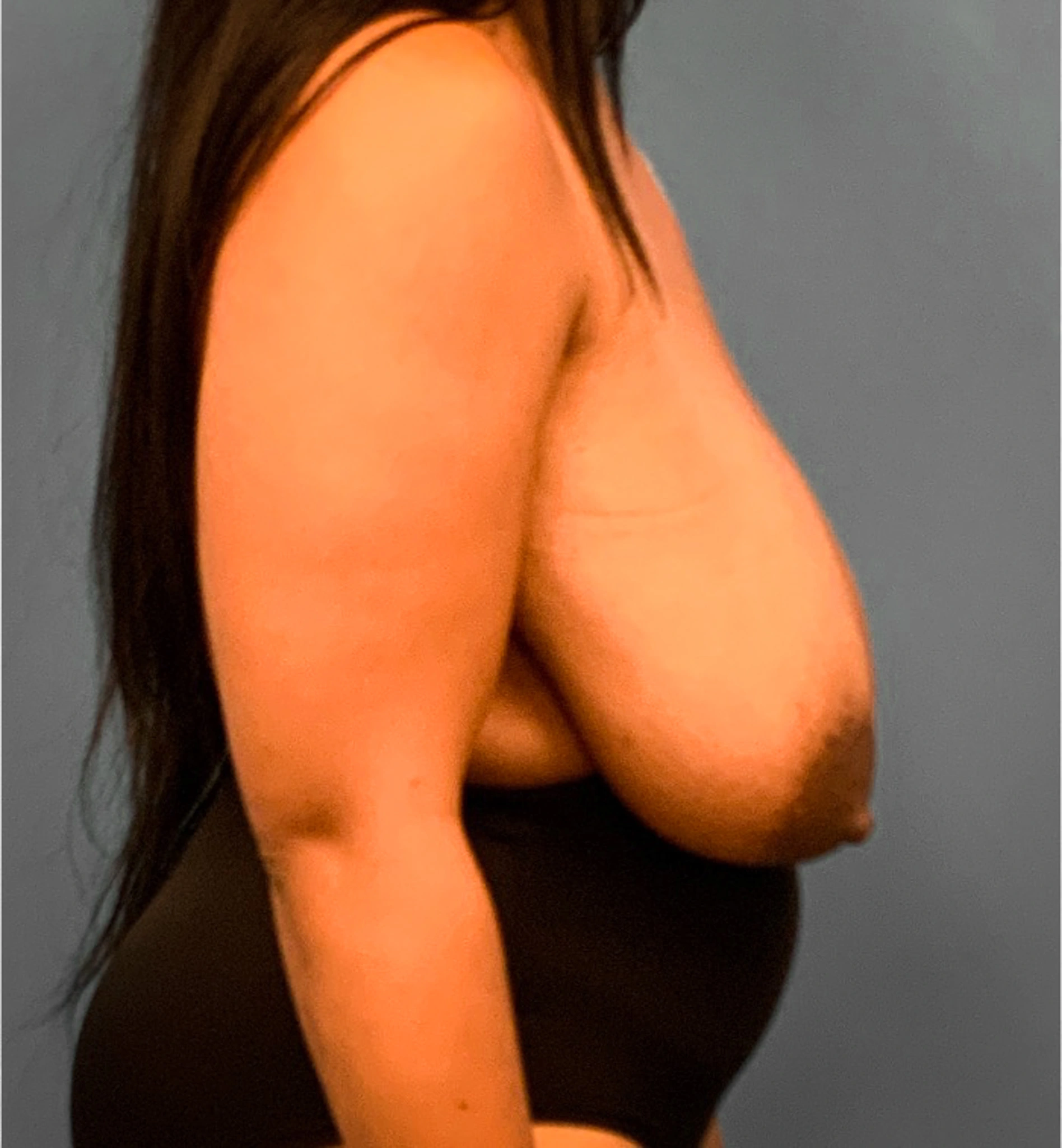 Breast-Reduction-Case--2564 | Before Breast Reduction 3