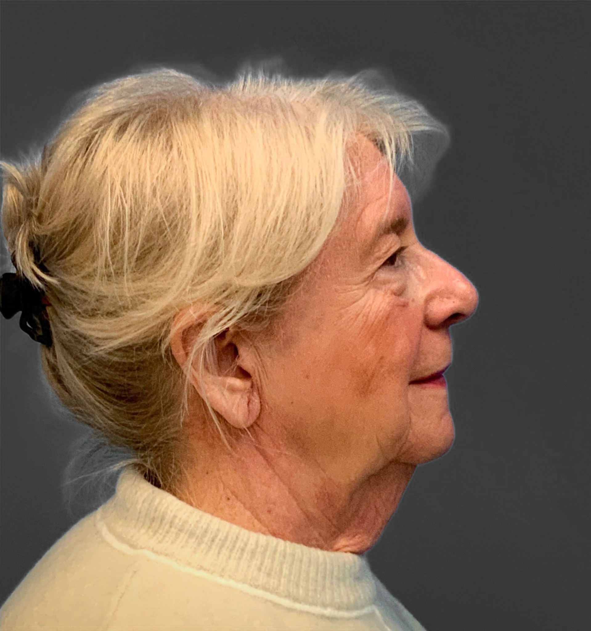 Blepharoplasty-Case--3336 | Before Eyelid Surgery 4