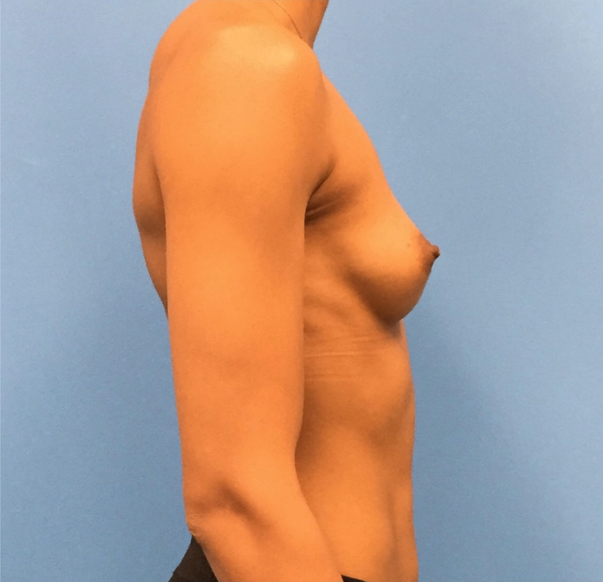 Breast-Augmentation-Case--221 | Before Breast Augmentation 2