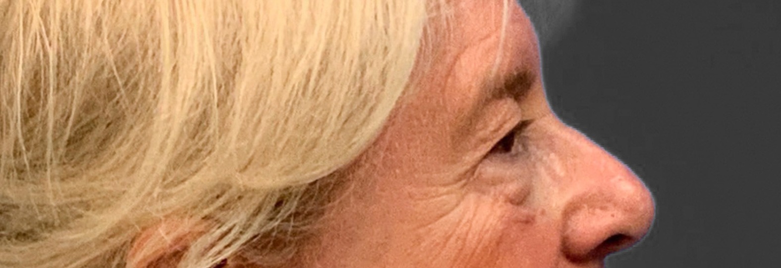 Blepharoplasty-Case--3336 | Before Eyelid Surgery 3