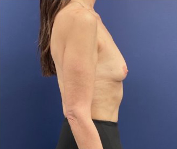 Subfascial-Breast-Augmentation-Case--26649 | Before Breast Augmentation 3