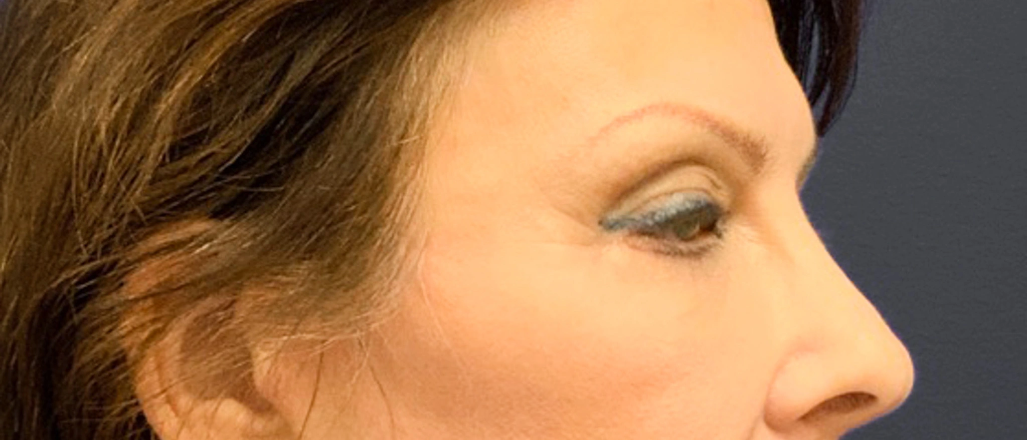 Blepharoplasty-Case--6272 | Before Eyelid Surgery 3