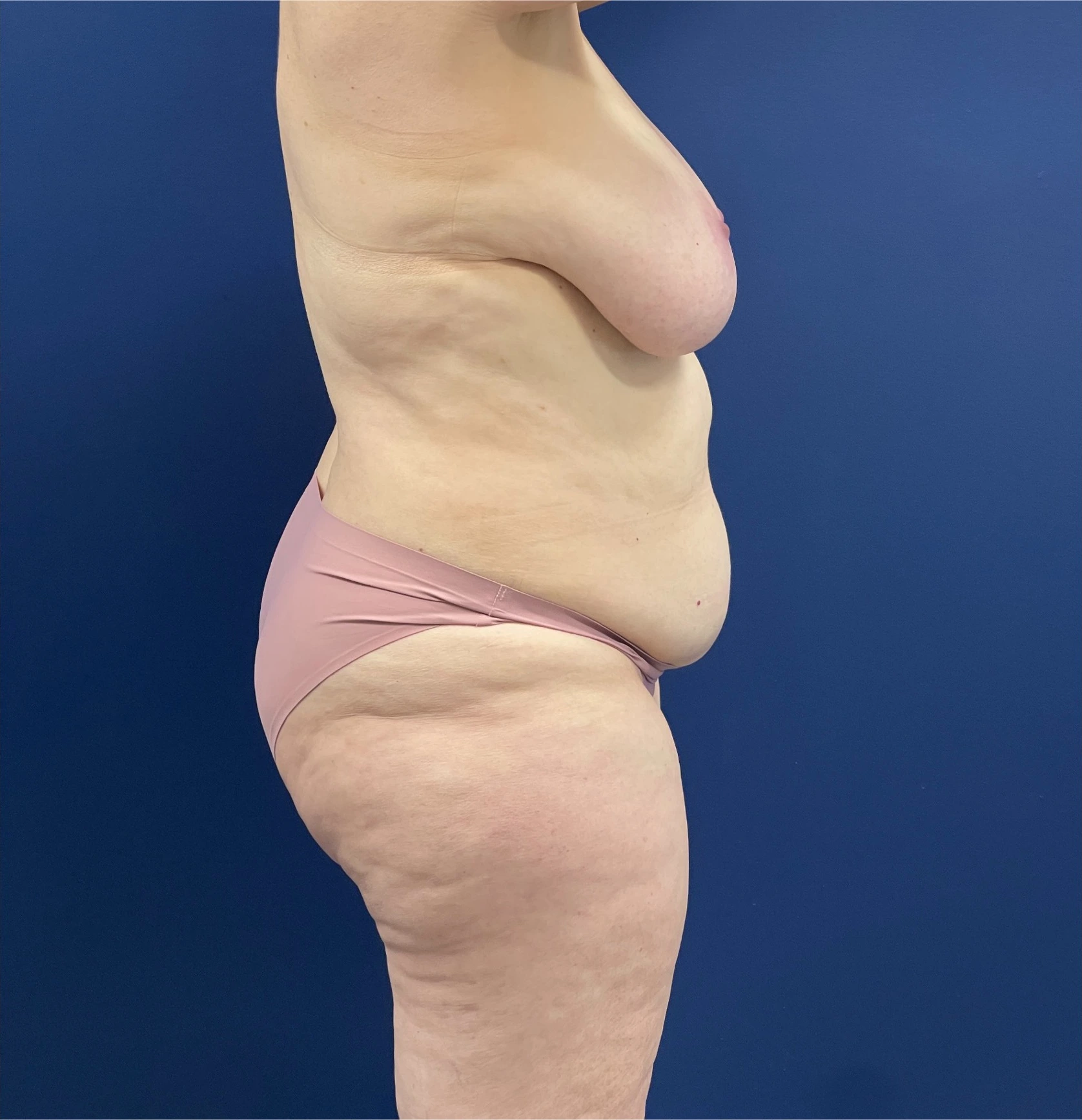 Mommy-Makeover-Case--26853 | Before Mommy Makeover 3