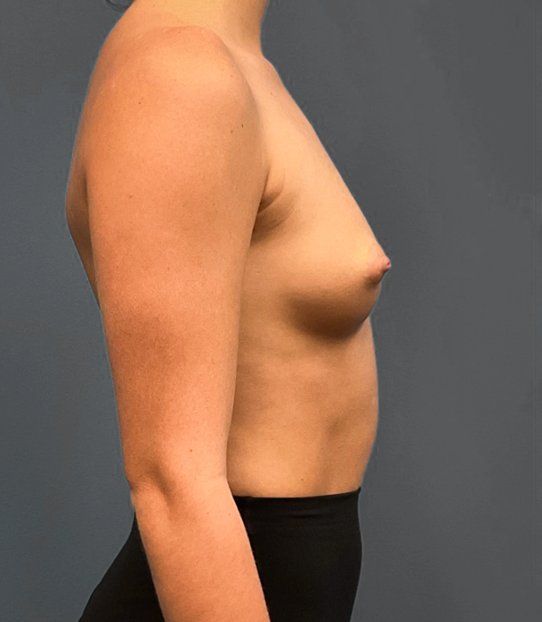 Breast-Augmentation-Case--2384 | Before Breast Augmentation 3