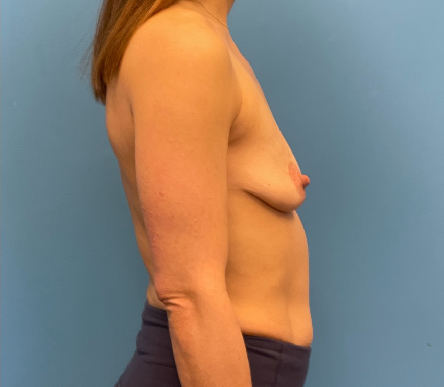 Breast-Augmentation-Mastopexy-Case--25025 | Before Breast Augmentation With Lift 3