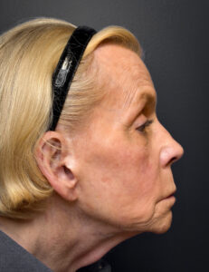 Facelift-Case--7247 | Before Facelift 2