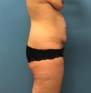 Abdominoplasty-Flank-Liposuction-Case--244 | Before Liposuction 2