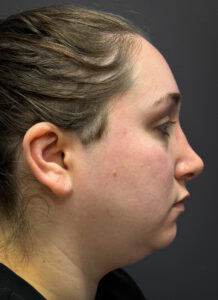 Submental-Liposuction-Case--3439 | Before Submental Liposuction 2