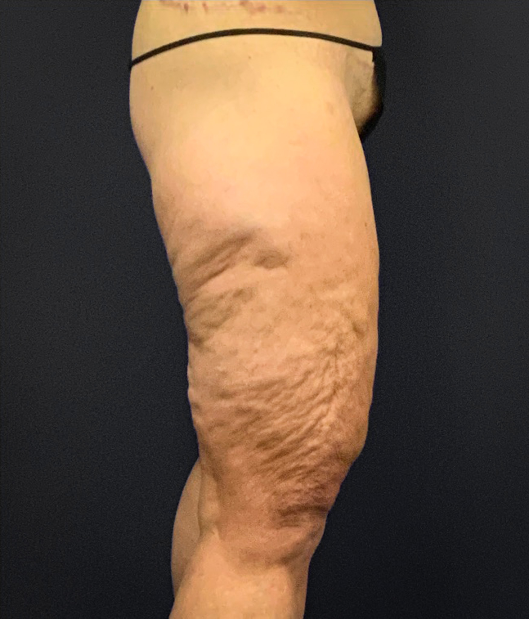 Thighplasty-Case--2024 | Before Thigh Lift 2