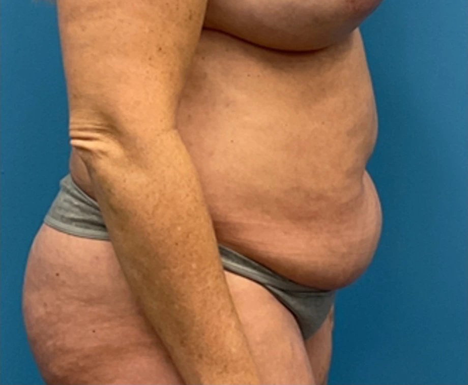 Liposuction-Tummy-Tuck-Case--25682-2 | Before Liposuction 5