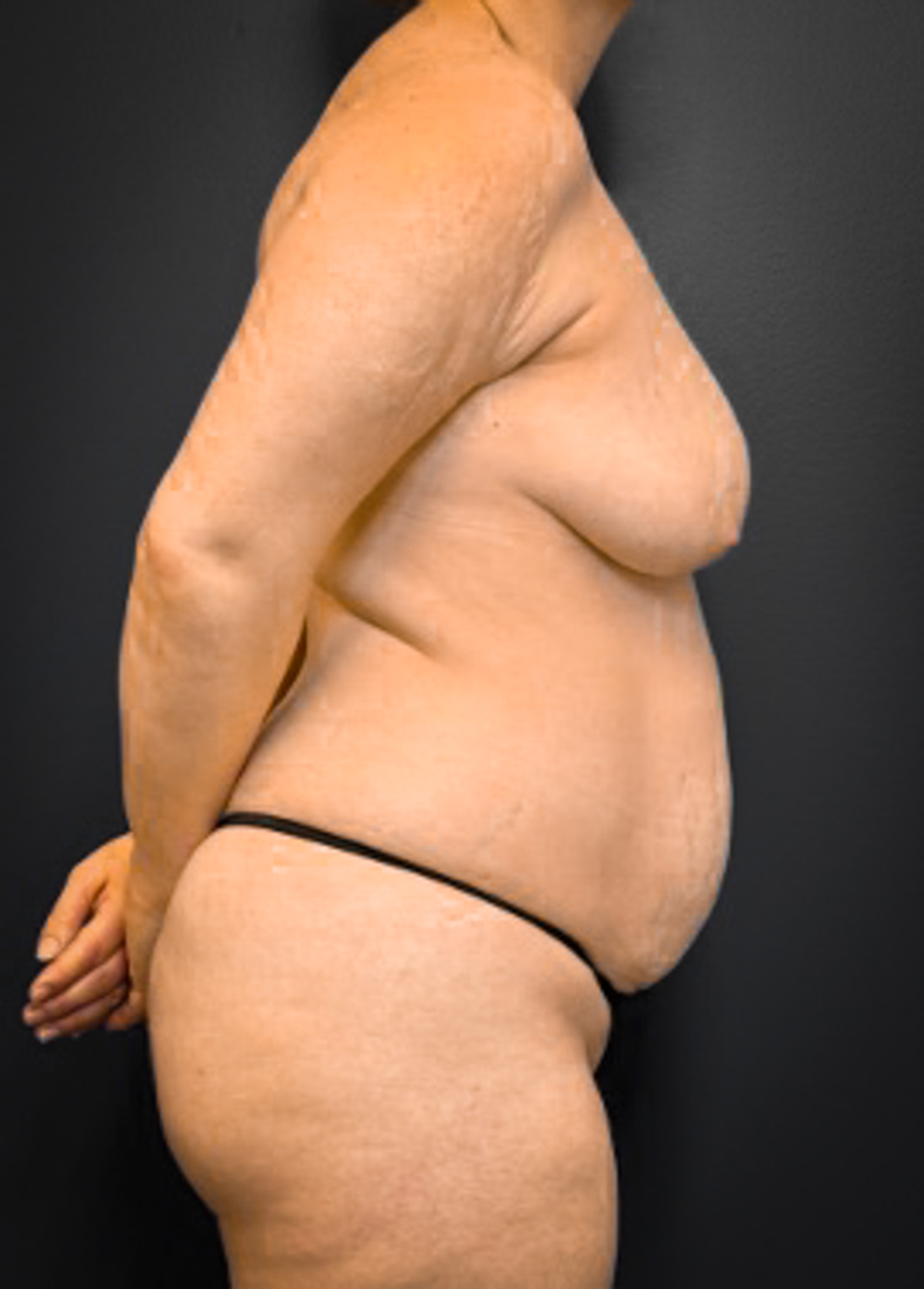 Abdominoplasty-Case--5347 | Before Tummy Tuck 3