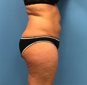 Liposuction-Case--72-1 | Before Liposuction 2