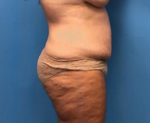 Case--252 | Before Mommy Makeover 2