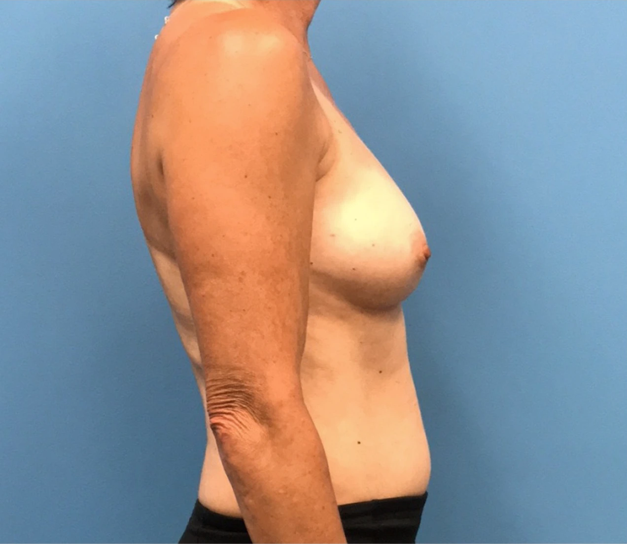 Breast-Reconstruction-Case--309 | Before Breast Reconstruction 2