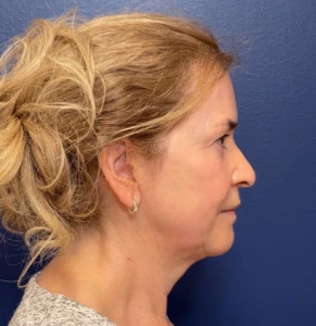 Facelift-Case--292 | Before Facelift 2