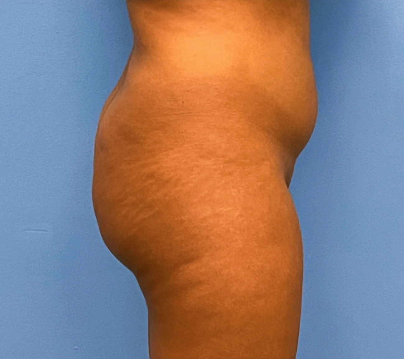 Brazilian-Butt-Lift-Case--263 | Before Brazilian Butt Lift 3