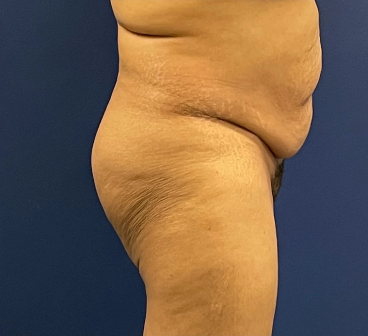 Brazilian-Butt-Lift-Case--215 | Before Brazilian Butt Lift 3