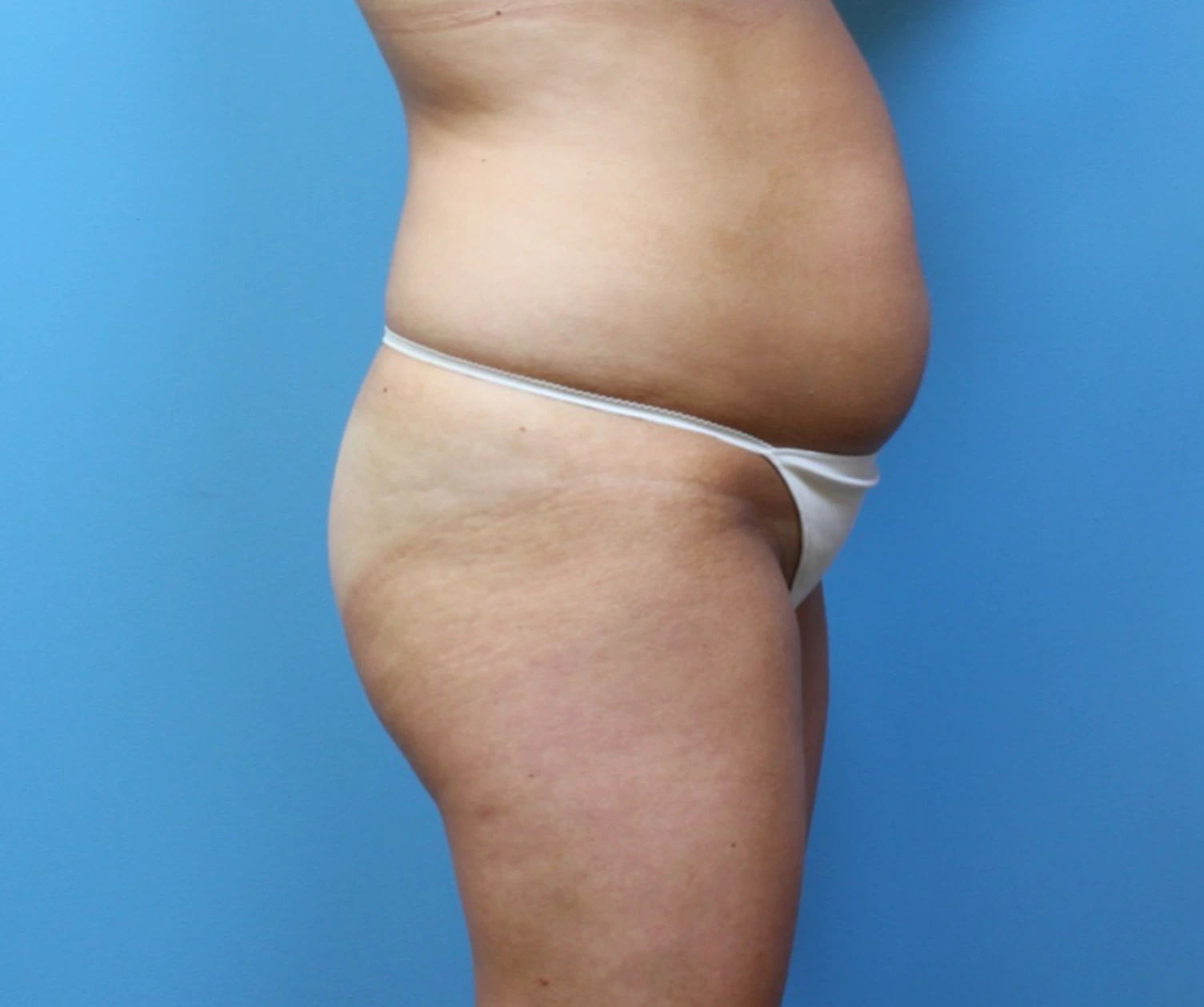 Brazilian-Butt-Lift-Case--265 | Before Brazilian Butt Lift 3