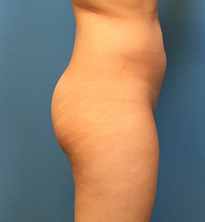 Brazilian-Butt-Lift-Case--73 | Before Brazilian Butt Lift 3