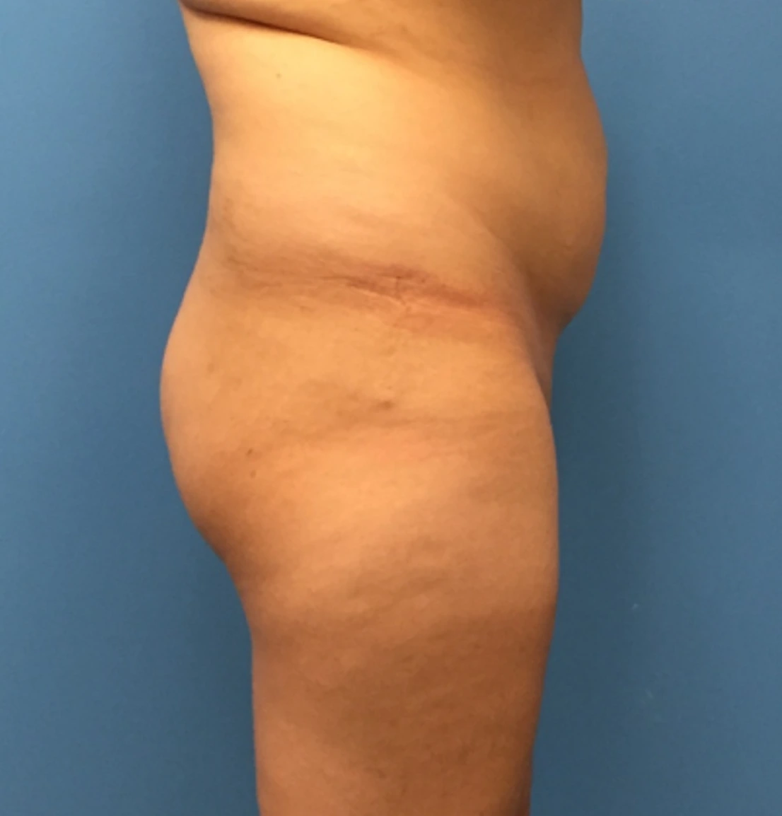 Brazilian-Butt-Lift-Case--272 | Before Brazilian Butt Lift 5