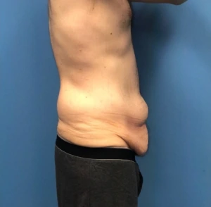 Body-Lift-Case--273 | Before Body Lift 2