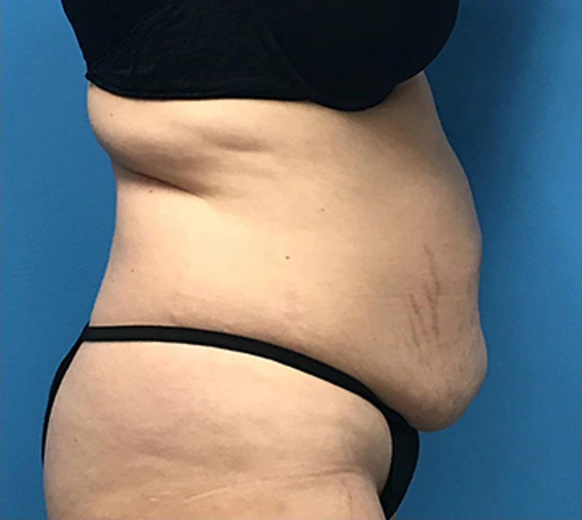 Case--56 | Before Liposuction 3