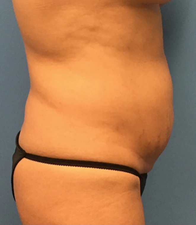Case--65 | Before Liposuction 3