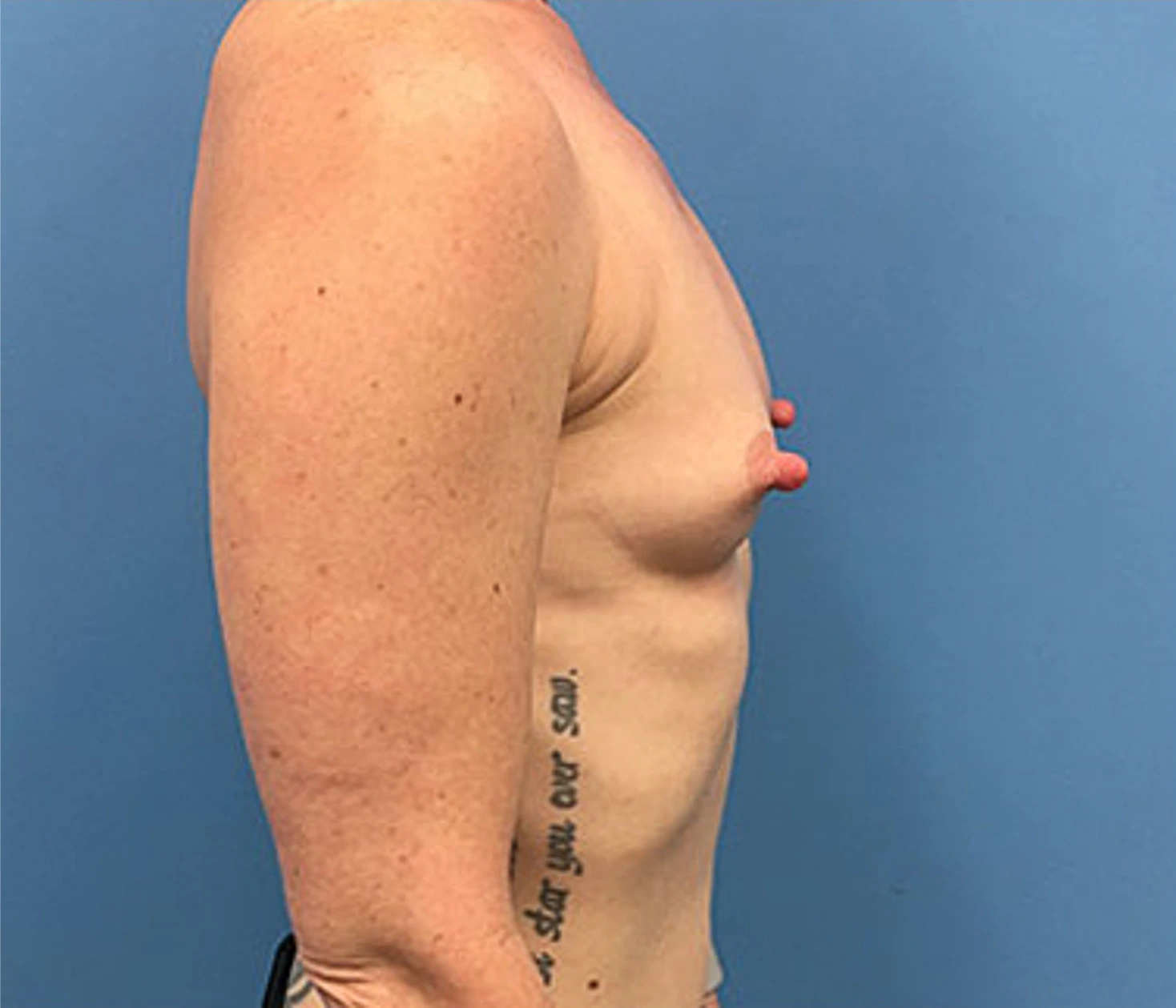 Case--88 | Before Breast Augmentation 5