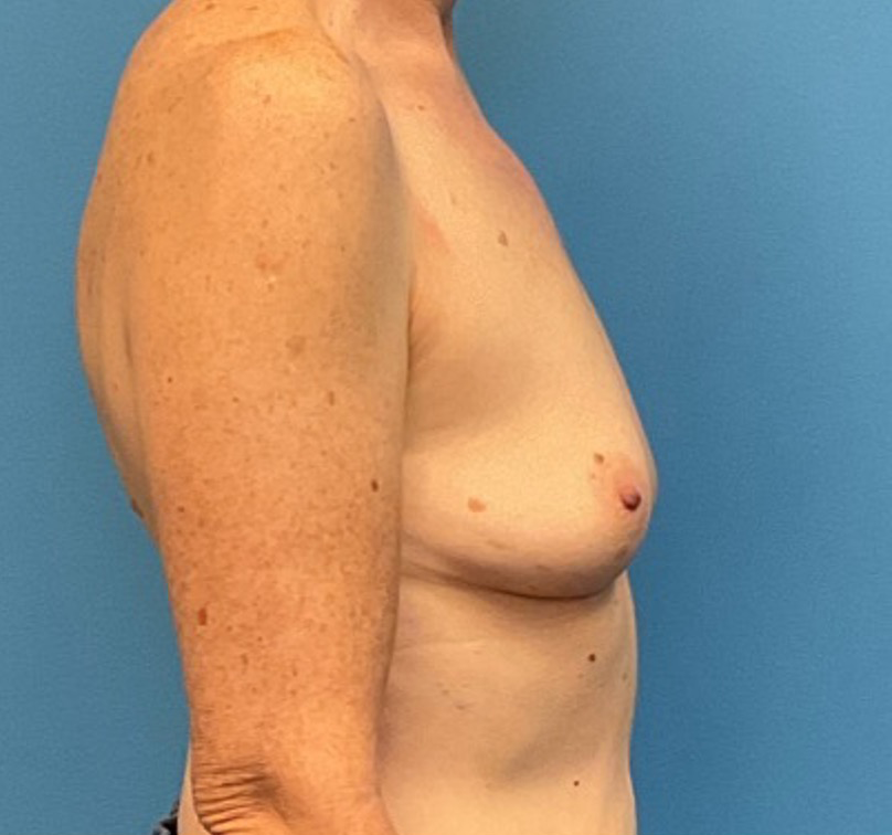 Breast-Augmentation-Case--27374 | Before Breast Augmentation 5