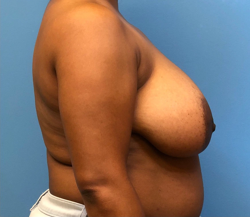 Breast-Reduction-Case--12894 | Before Breast Reduction 3