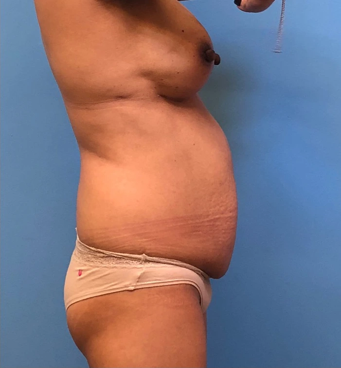 Case--11542 | Before Breast Reconstruction 3