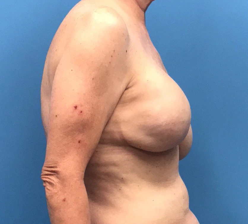 Case--10040 | Before Breast Reconstruction 3