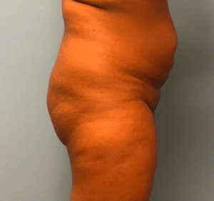 Brazilian-Butt-Lift-Case--13244 | Before Brazilian Butt Lift 2