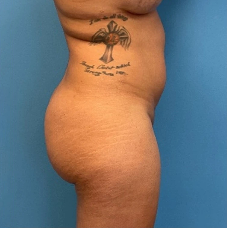 Case--25704 | Before Liposuction 3