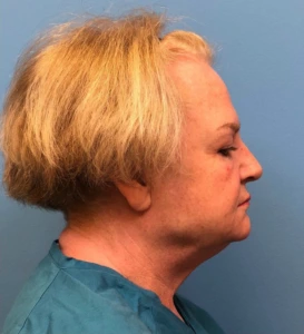 Facelift-Case--14460 | Before Dr. Samir Rao 2