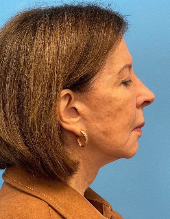 Facelift-Case--25941 | Before Facelift 3