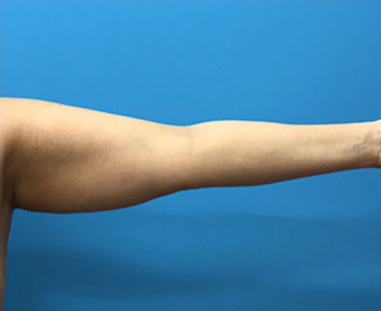 Brachioplasty-Case--78 | Before Arm Lift 3