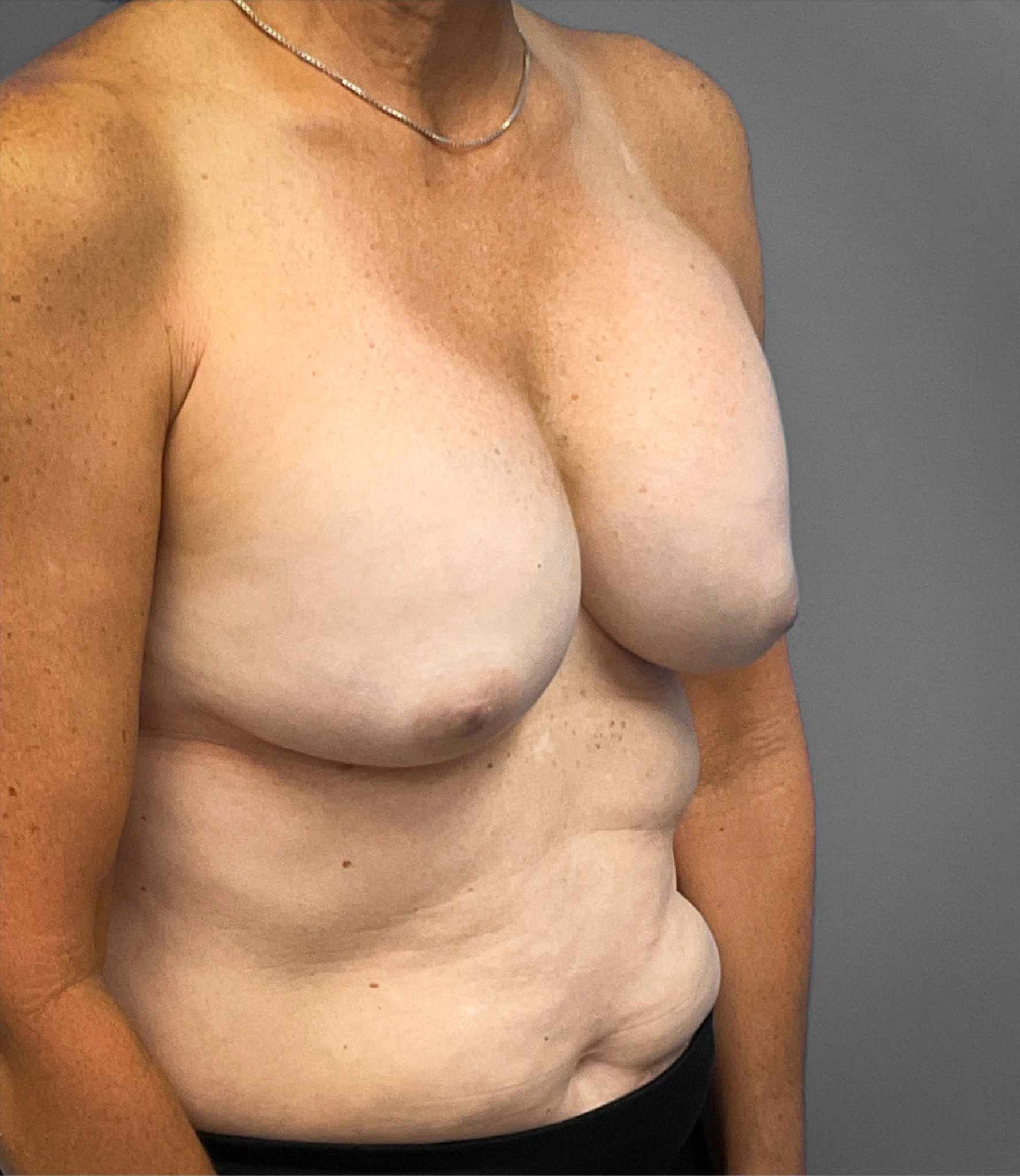 Augmentation-Mastopexy-Case--1213 | Before Breast Augmentation With Lift 3