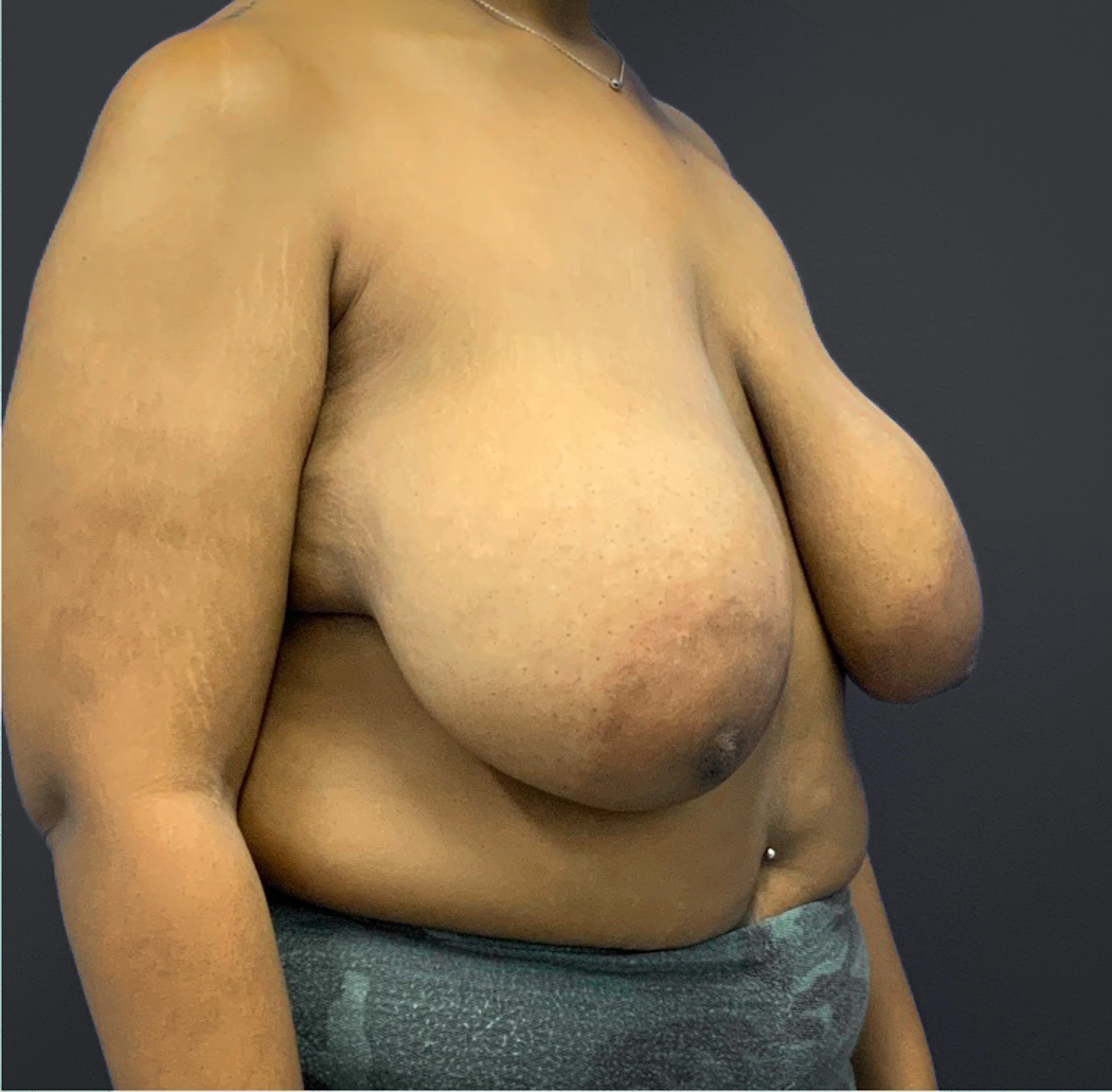 Breast-Reduction-Case--5320 | Before Breast Reduction 5