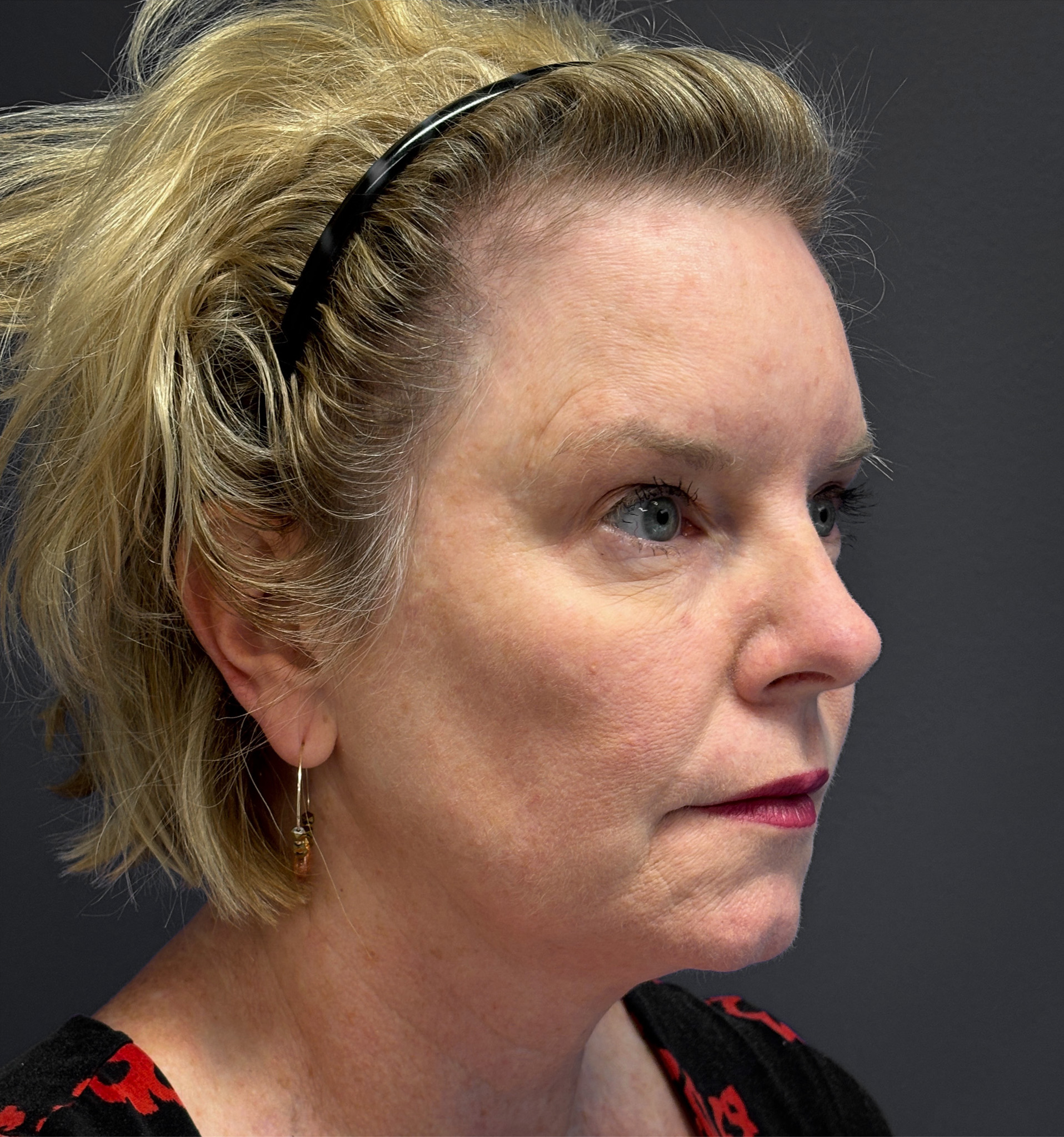 Blepharoplasty-Case--7015 | Before Eyelid Surgery 6