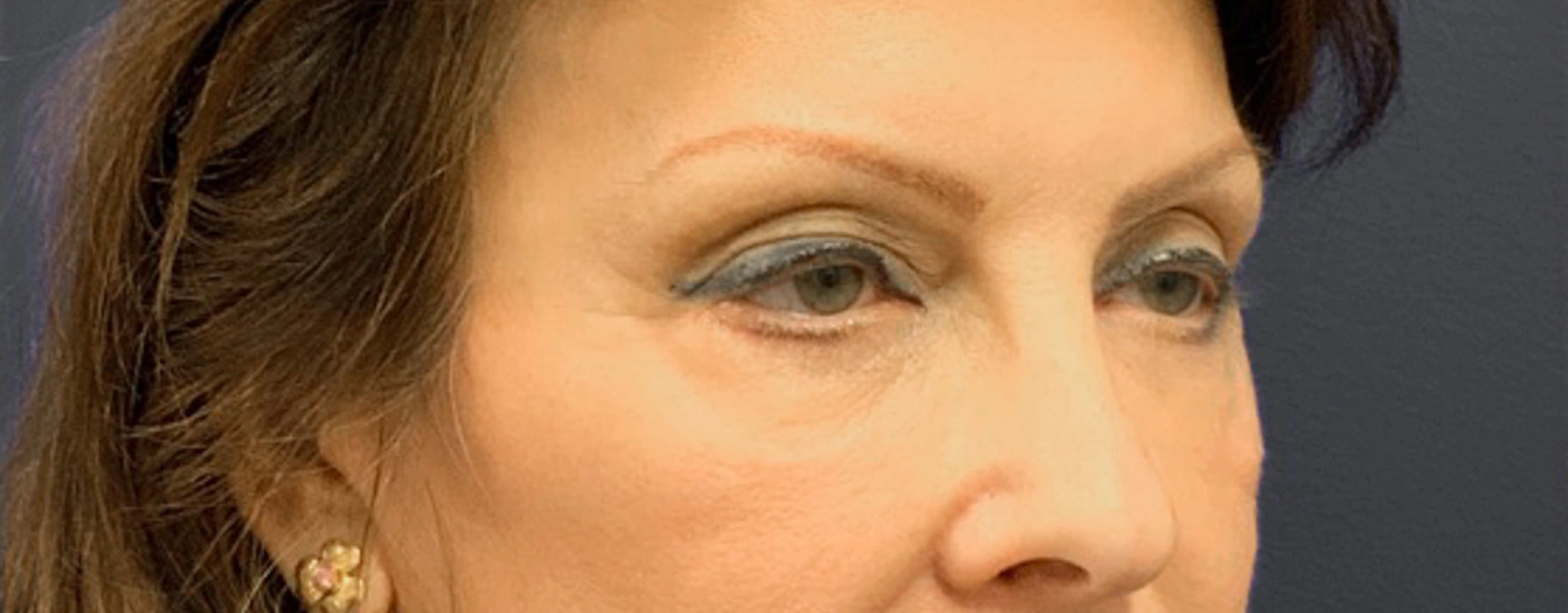 Blepharoplasty-Case--6272 | Before Eyelid Surgery 9