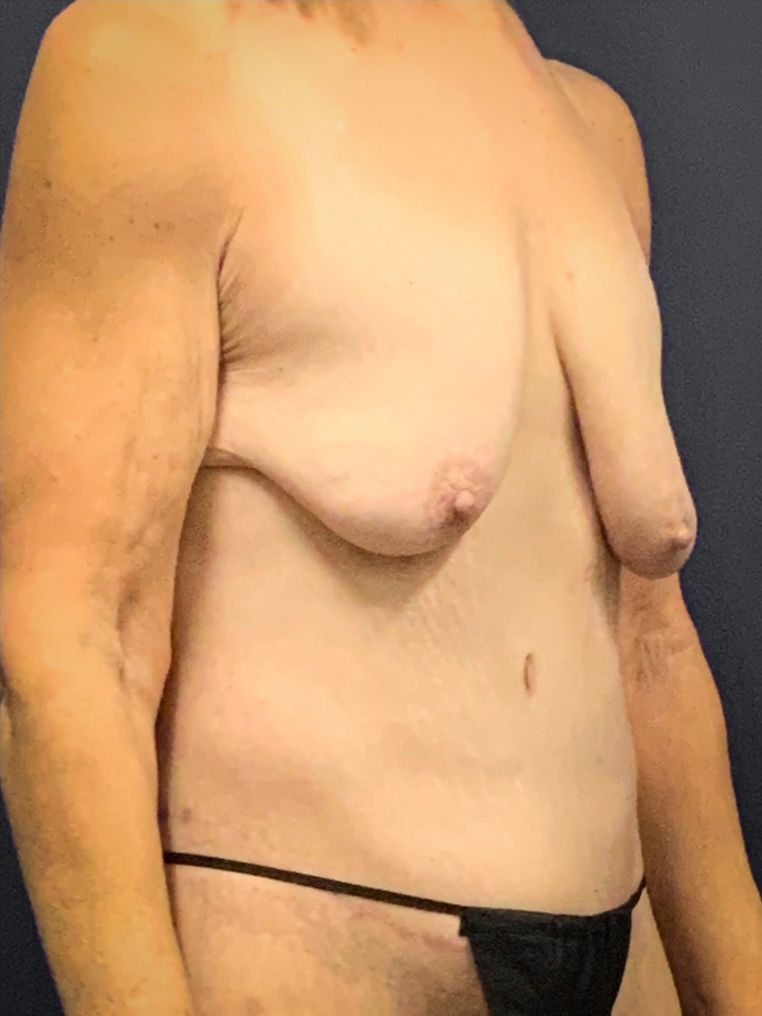Augmentation-Mastopexy-Case--3055 | Before Breast Augmentation With Lift 5