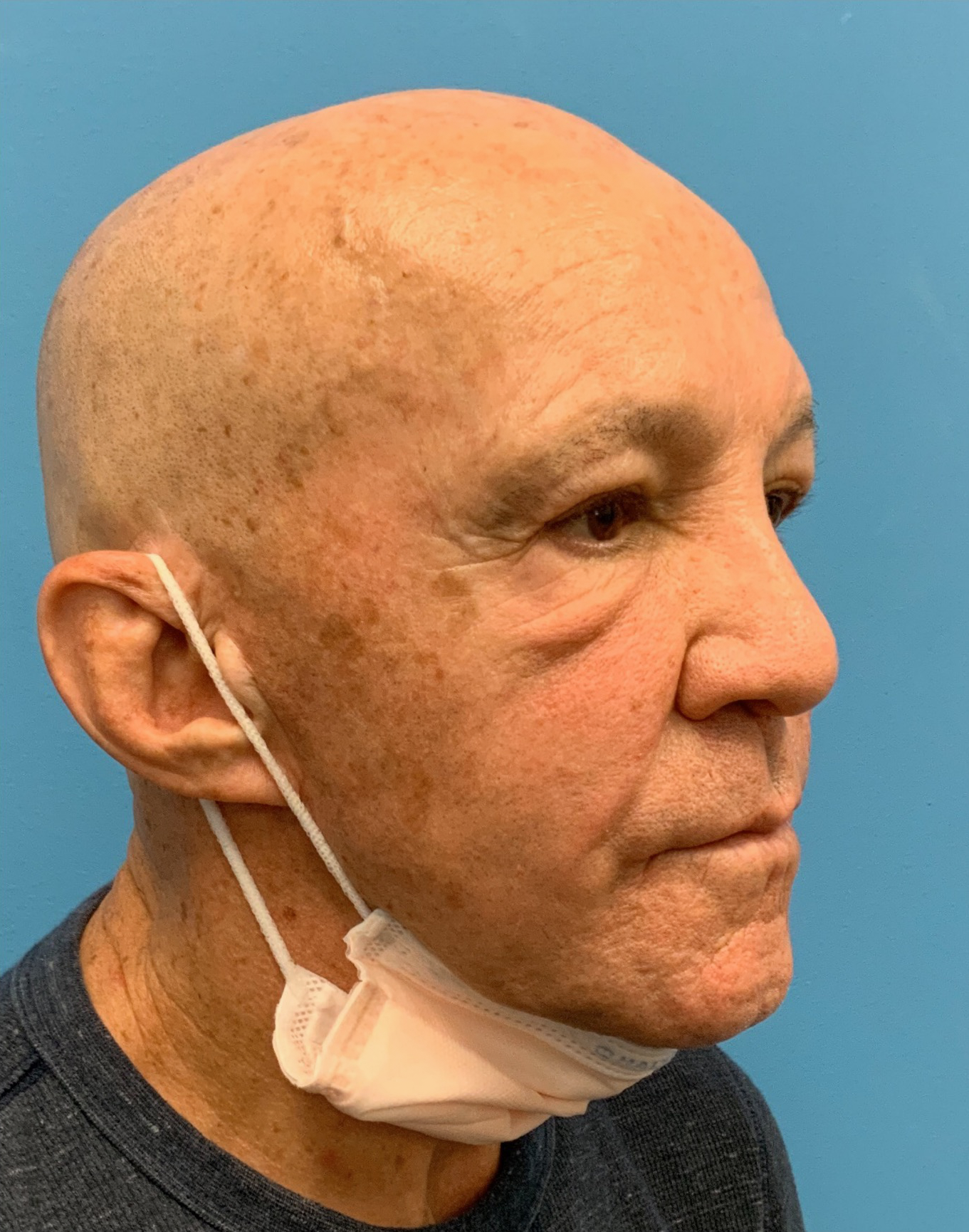 Blepharoplasty-Case--24169 | Before Eyelid Surgery 4