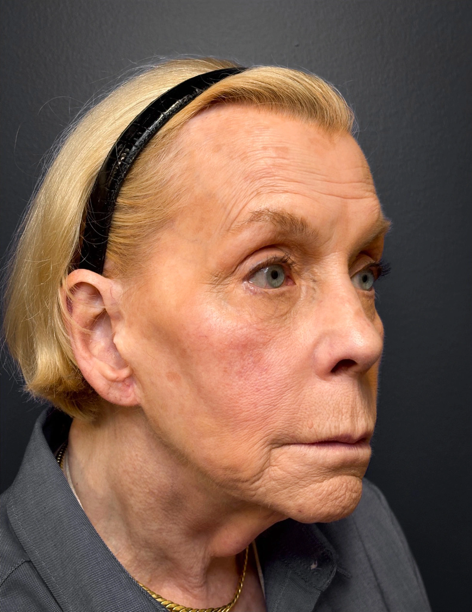 Facelift-Case--7247 | Before Facelift 4